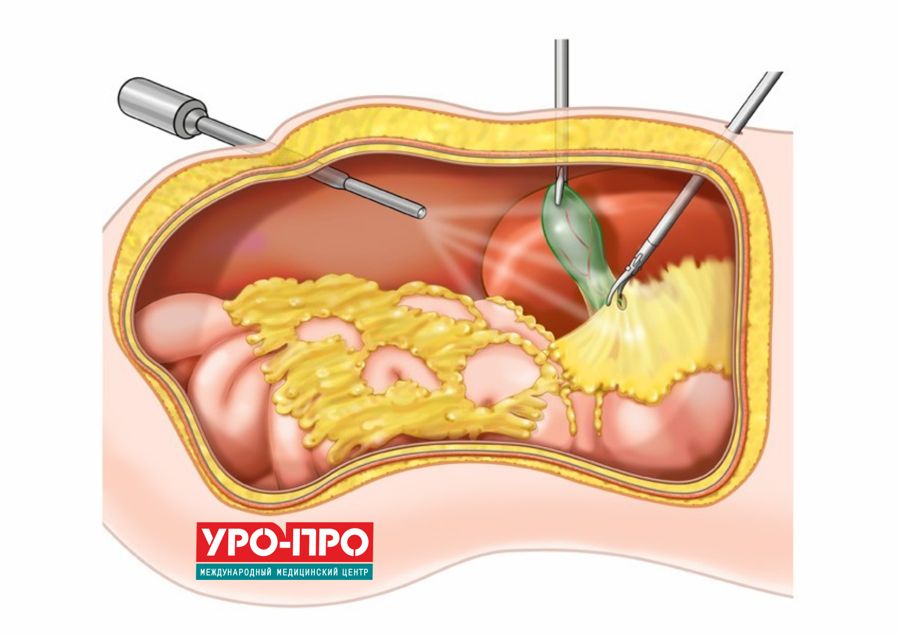 Лишний Вес После Холецистэктомии