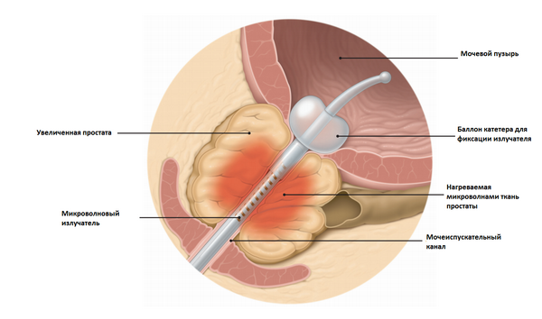 Prostatit katéter