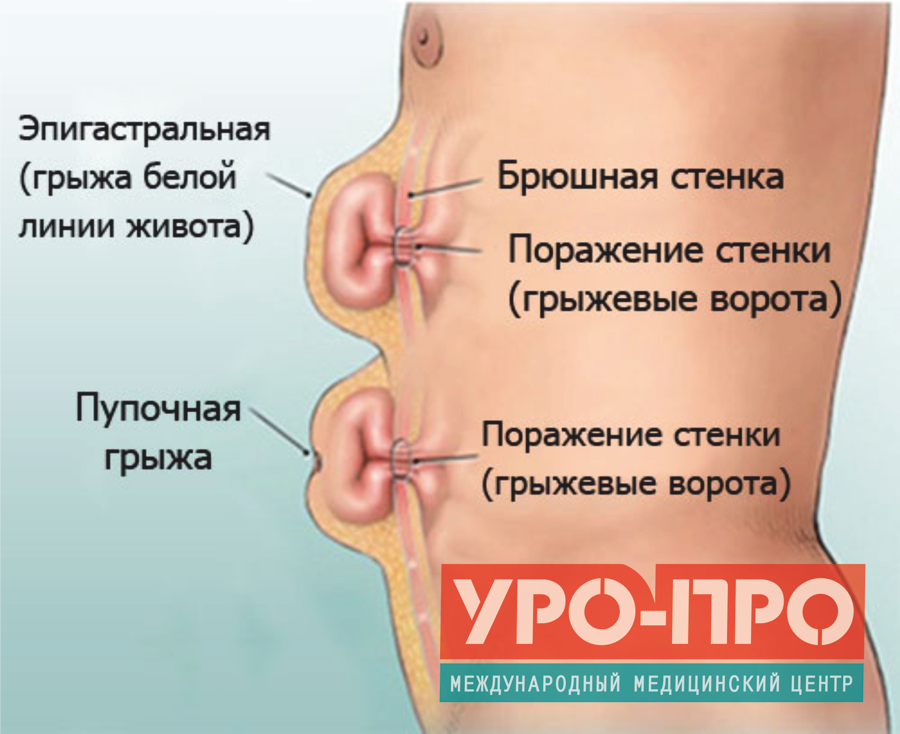 Грыжа белой линии живота операция в краснодаре