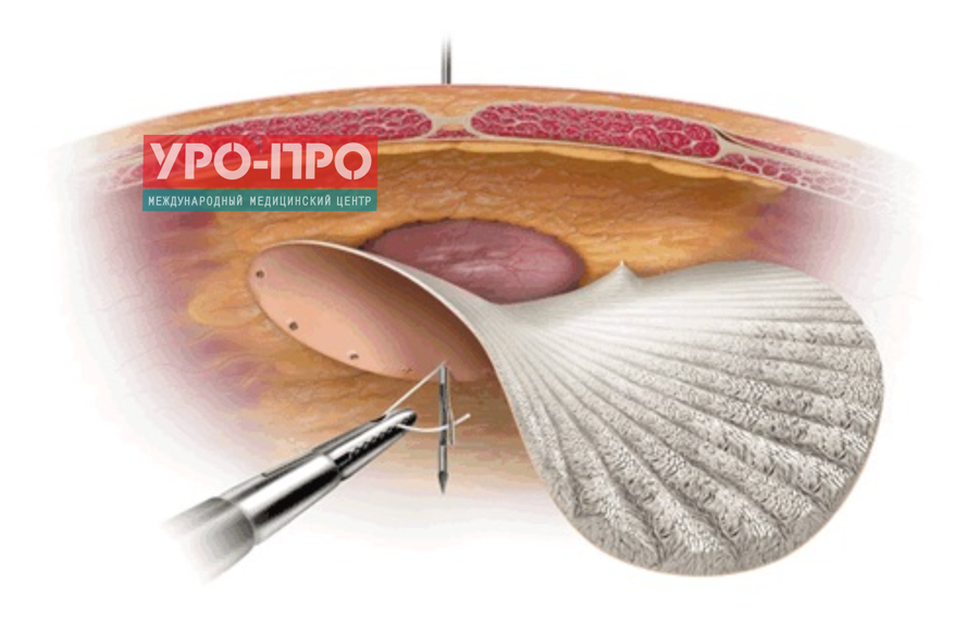 Грыжа белой линии живота операция в краснодаре