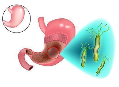 Бактерия Helicobacter pylori