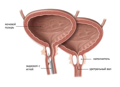 физиотерапия для лечения гиперактивного мочевого пузыря