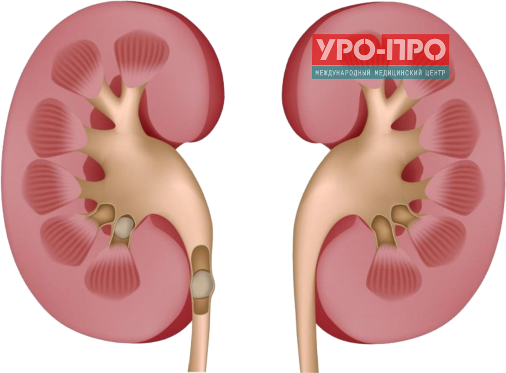 Камень в почках лечение краснодар