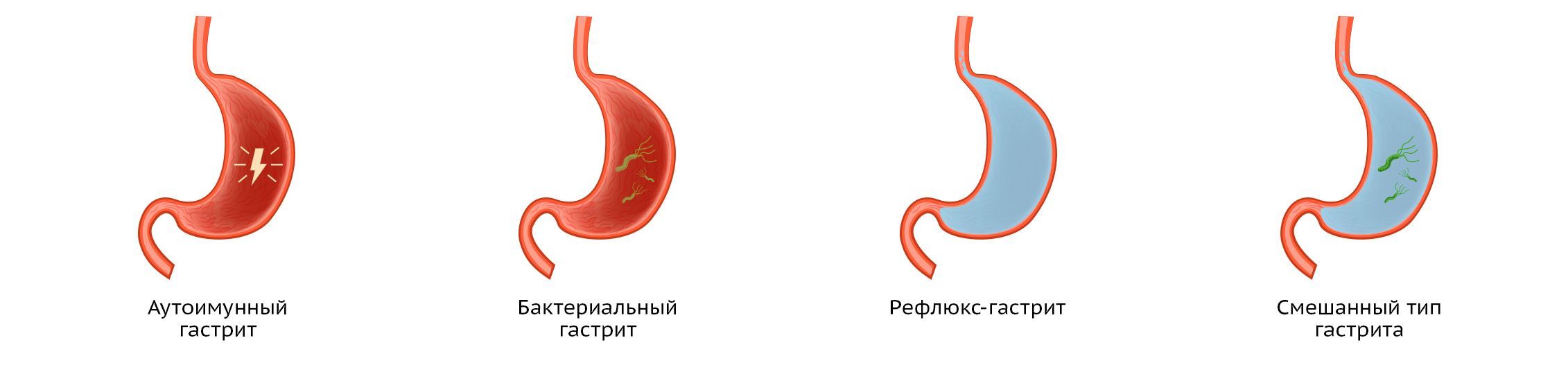 Хронический гастрит