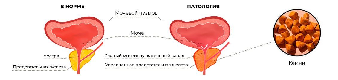 Калькулезный простатит