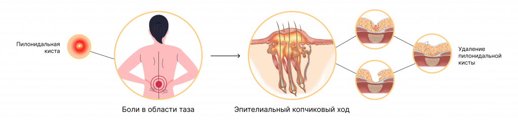 Эпителиально копчиковый мкб 10. Эпителиальный копчиковый ход (ЭКХ). Пилонидальная болезнь. Эпителиальная копчиковая киста.