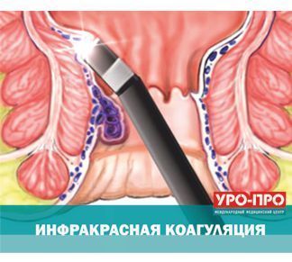 Инфракрасная коагуляция Инфракрасная коагуляция