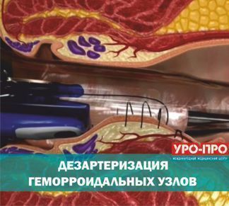 Дезартеризация геморроидальных узлов Дезартеризация геморроидальных узлов