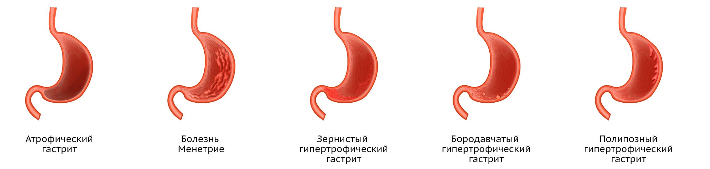 Гастрит