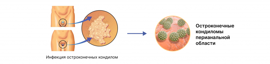 Кондиломы перианальной области