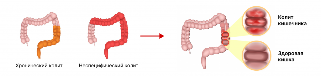 Колит кишечника