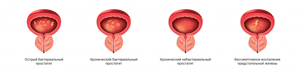 Простатит