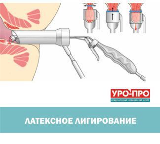 Латексное лигирование Латексное лигирование