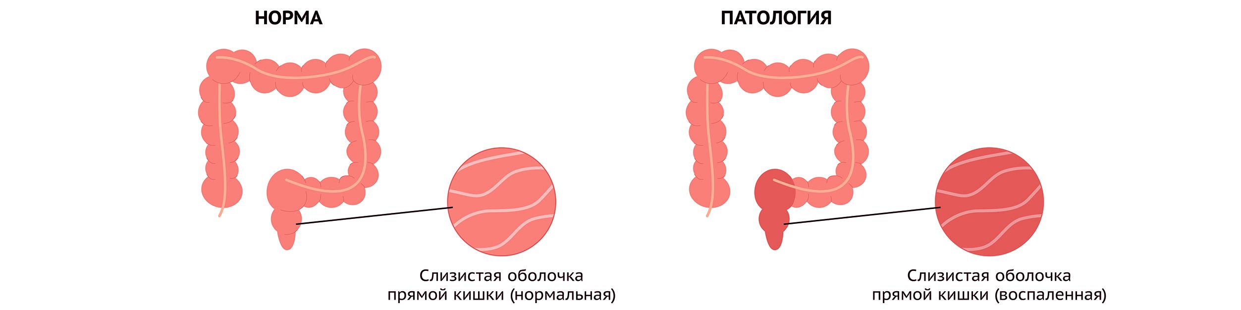 Лучевой проктит