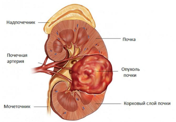 к_факторам_риска_рака_почки_относится_1.png