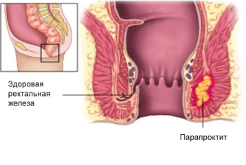 Парапроктит