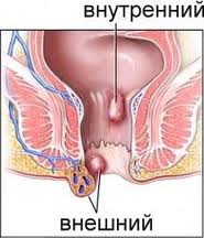 Геморрой внешний и внутренний