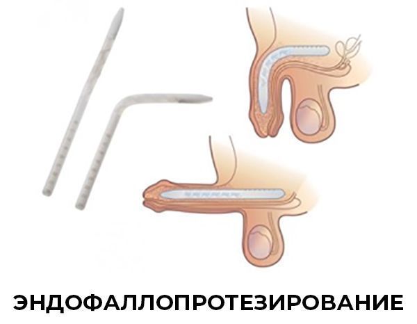 Протезирование полового члена в Краснодаре. Клиника УРО-ПРО