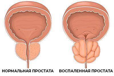 Лечение простатита и аденомы простаты в УРО-ПРО