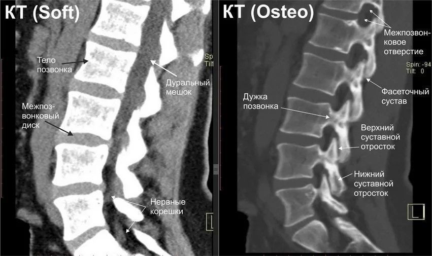 Патологии при КТ позвоночника