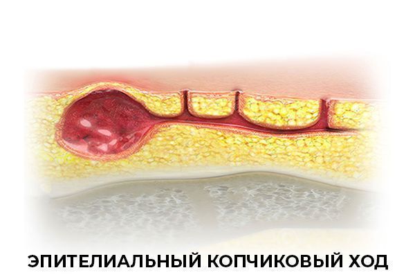 Эпителиальный копчиковый ход. Лечение в Краснодаре. Клиника УРО-ПРО