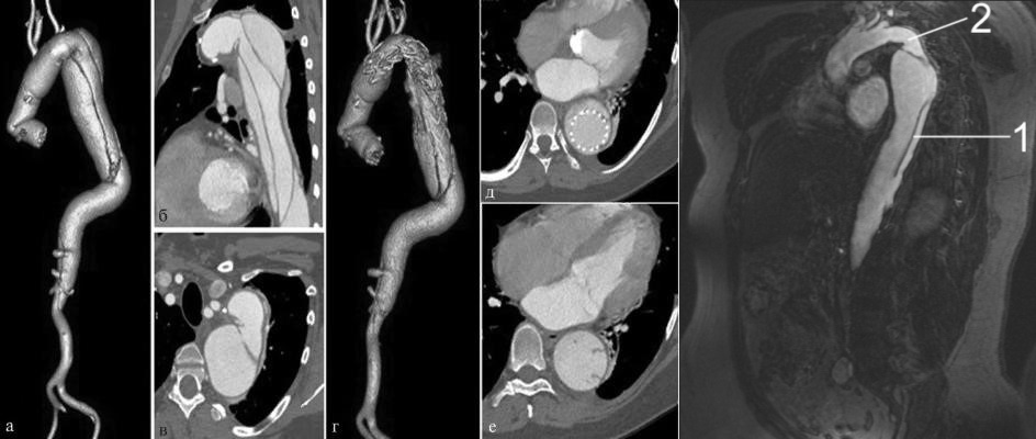 Результаты исследования аорты