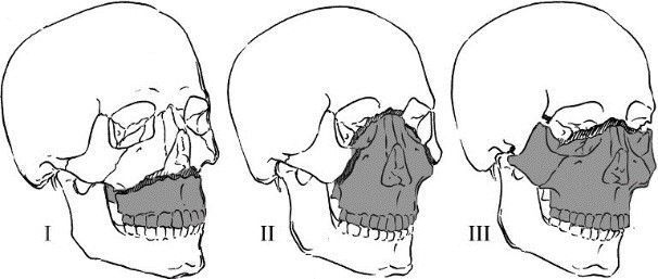 переломы средней части лица