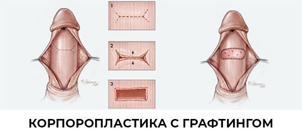 Лечение болезни Пейрони в Краснодаре. Клиника УРО-ПРО