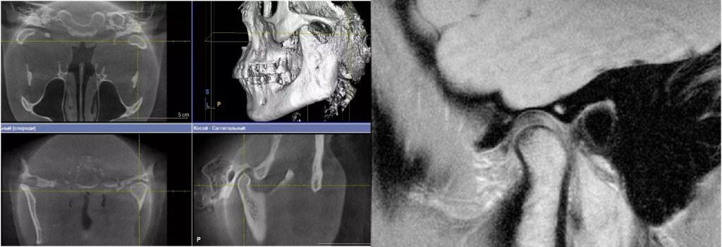 исследование височно-нижнечелюстного сустава