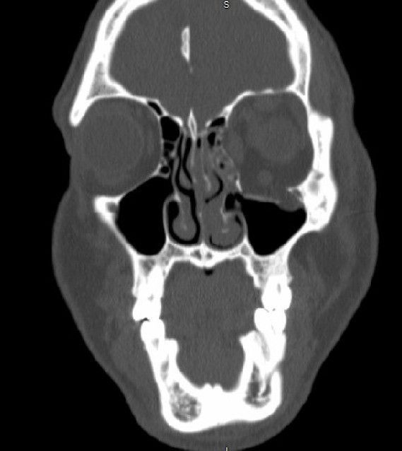 Томограмма глазных орбит, демонстрирующая перелом дна левой глазницы с грыжей в левую верхнечелюстную пазуху.