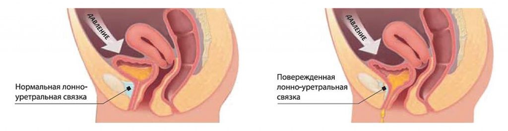 Лечение недержания мочи у женщин в Краснодаре. Клиника УРО-ПРО