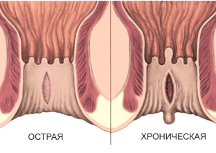 Анальная трещина