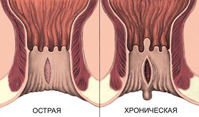 Анальная трещина.jpg