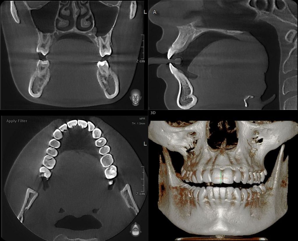 Полученные данные КТ челюсти