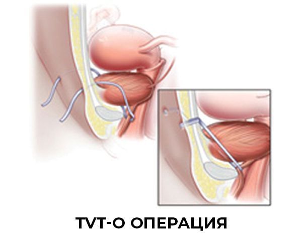 Лечение недержания мочи у женщин. Клиника "УРО-ПРО" в Краснодаре