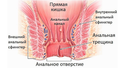Анальная трещина