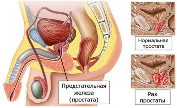 Рак предстательной железы это.png