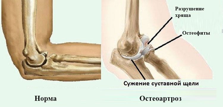 Остеоартроз локтевого сустава