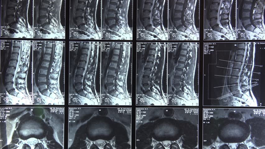 Результаты КТ позвоночника
