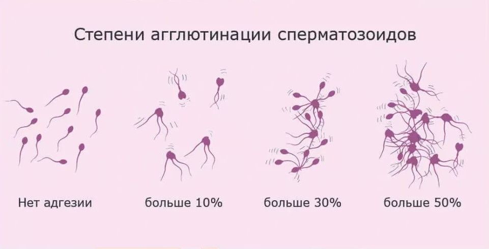 Степени агглютинации сперматозоидов