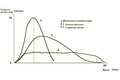 Урофлоуметрия. Исследования в клинике УРО-ПРО