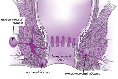 Парапроктит.jpg