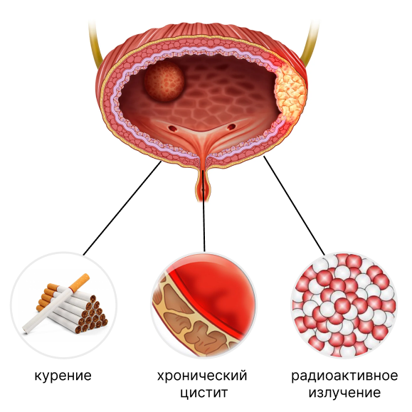 Факторы риска развития опухоли мочевого пузыря