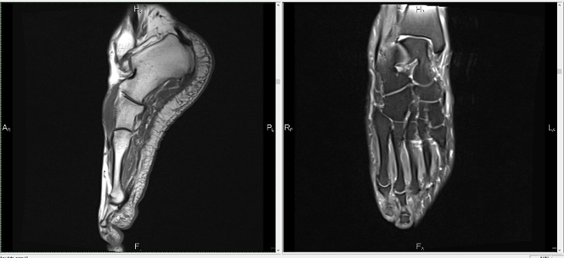 Результаты КТ стопы