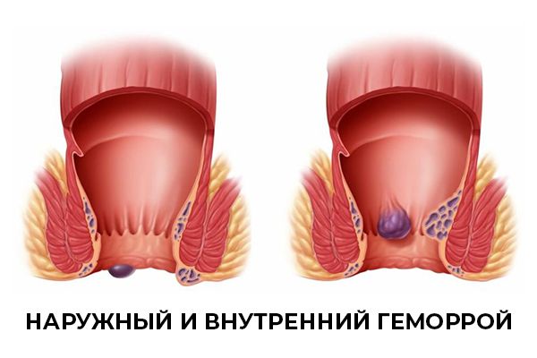 Лечение геморроя в Краснодаре. Клиника УРО-ПРО