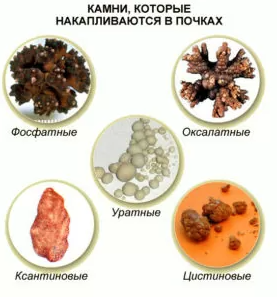 камни в почках камни в почках