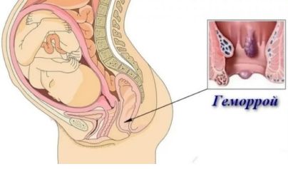 Почему появляется или обостряется геморрой