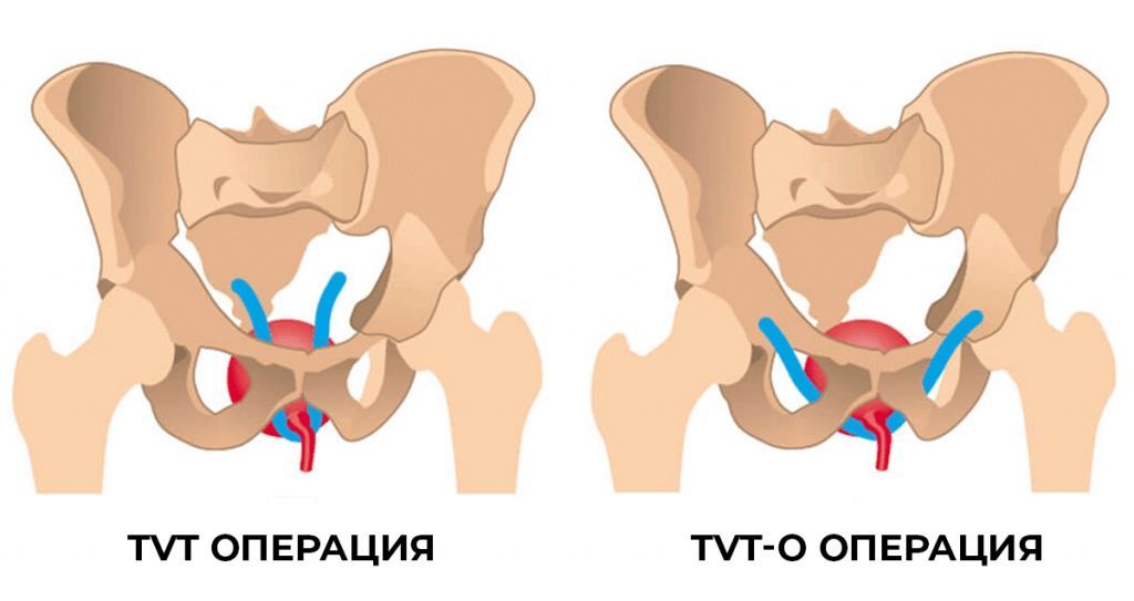 Лечение недержания мочи в Краснодаре. Клиника УРО-ПРО