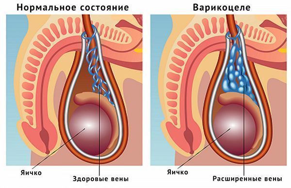 варикоцеле Лечение варикоцеле в Краснодаре. Клиника УРО-ПРО