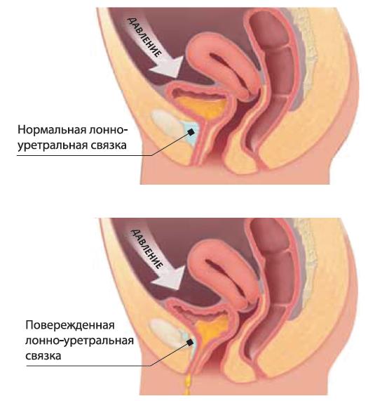 недержание мочи недержание мочи